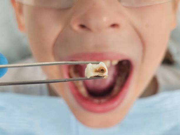 Best Emergency Tooth Extraction in Clifton, IL